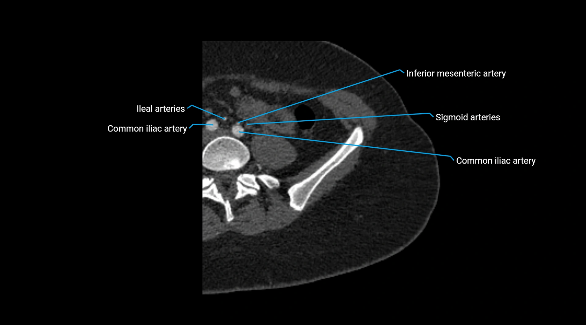 CTA lower limb cross sectional anatomy labelled image _8.webp
